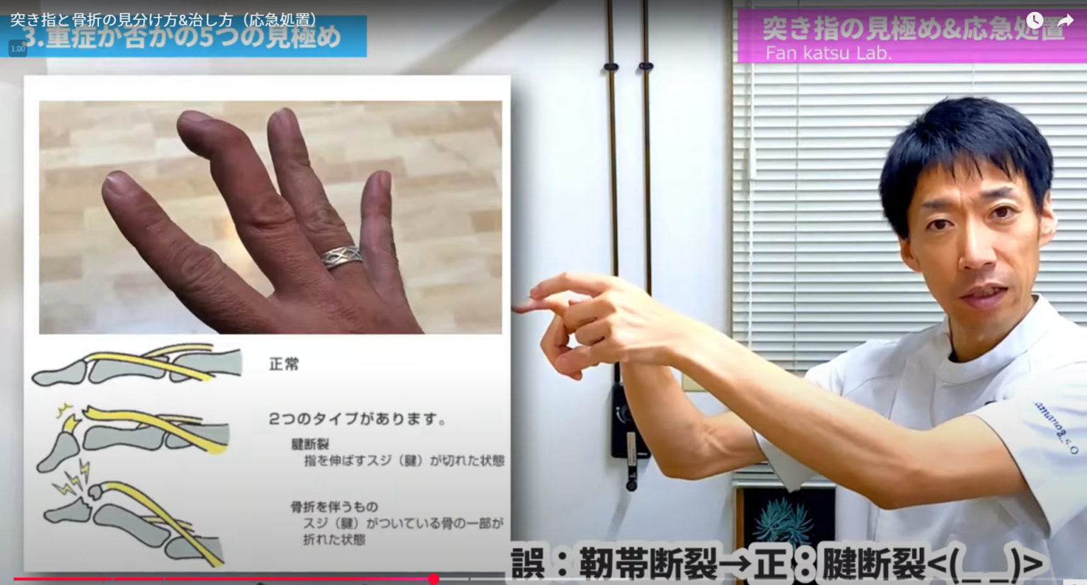 突き指 あざ | 手の指に壁がぶつかる : 突き指の治し方！薬指や小指も中指も治し方は全部同じ – JSDY